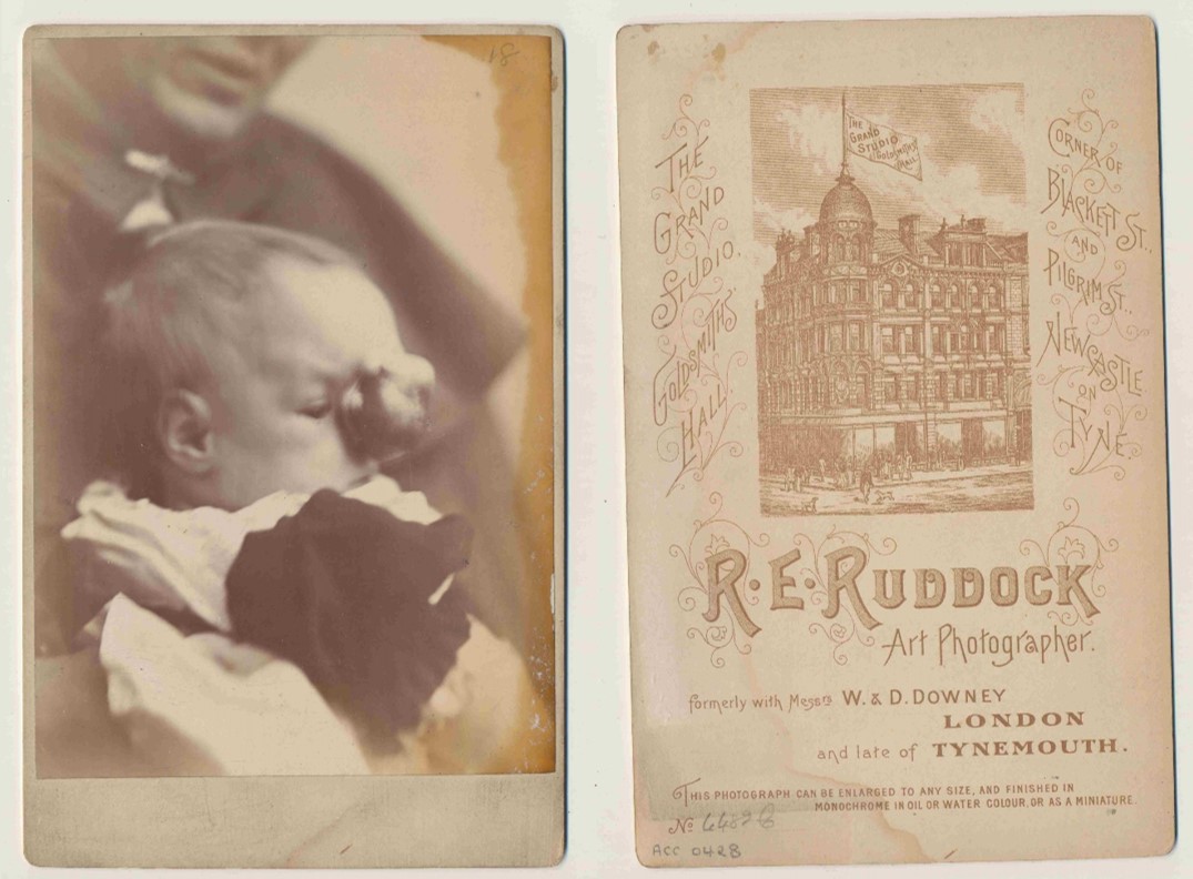 Clinical Cabinet Card made by RE Ruddock Photographic Studio in Newcastle-on-Tyne